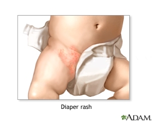 Diaper rash_Adam